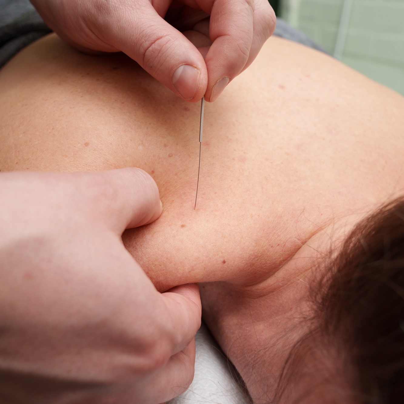 Sinun Hierojasi Dry Needling Kuivaneulaus